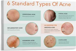 Different Types of Acne Poster (4) Canvas Print Wall Art Decor Living Room Office Bedroom 18x12inch(45x30cm) Frame-style